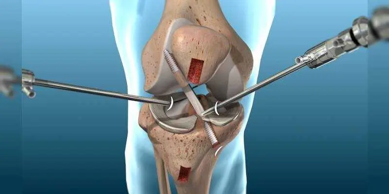 Artroscopia de rodilla. Foto: orthoist.com