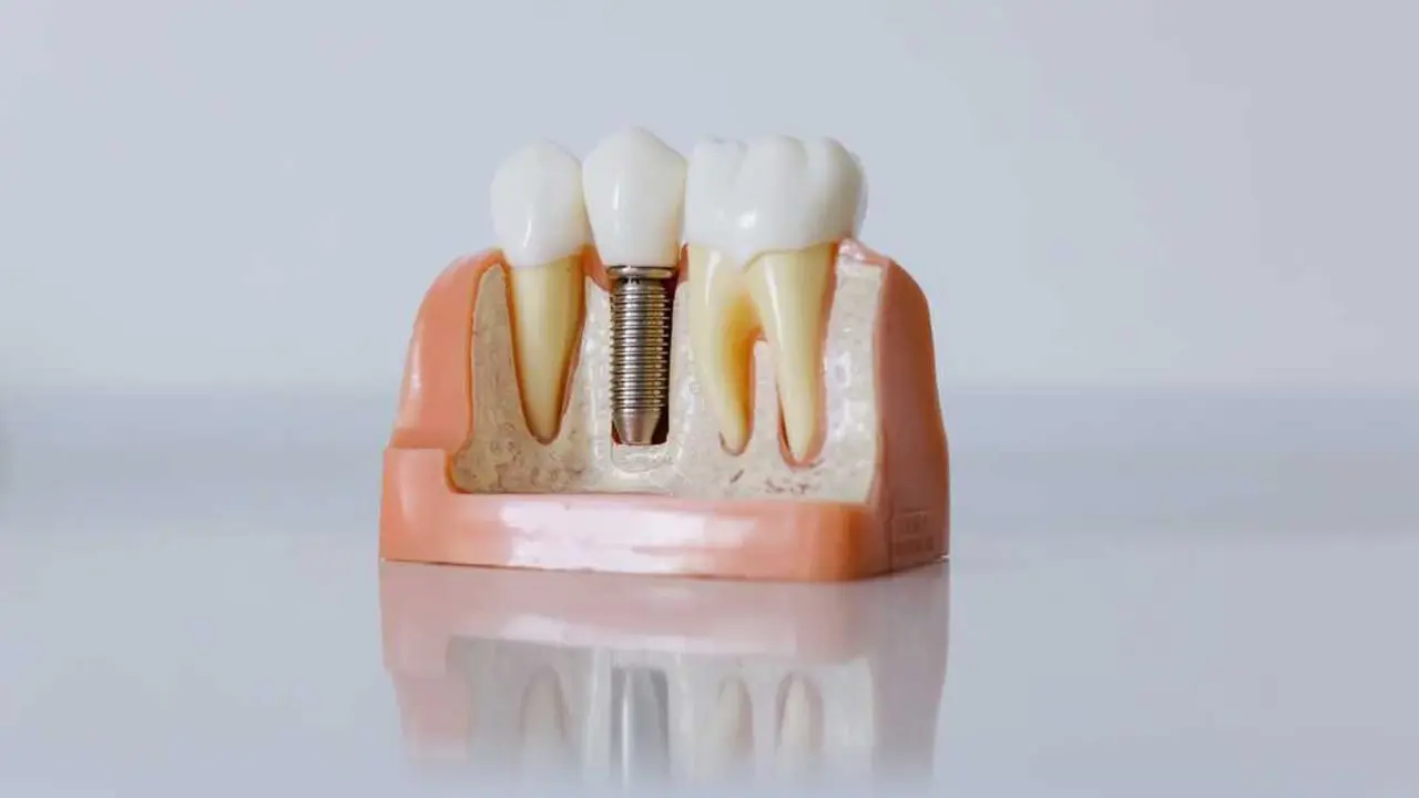 Representaci&oacute;n de un implante dental. Foto: Pixabay.com