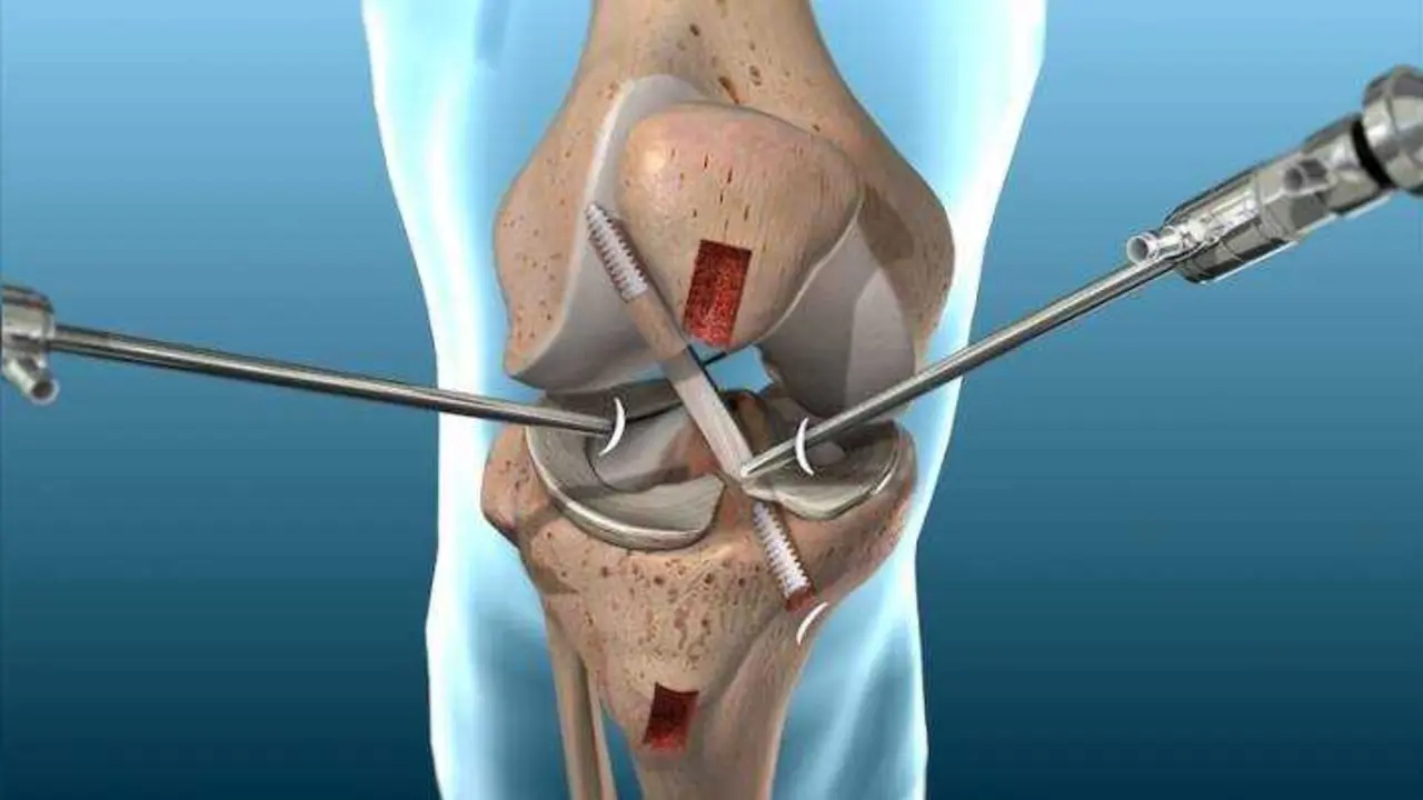 Artroscopia de rodilla. Foto: orthoist.com