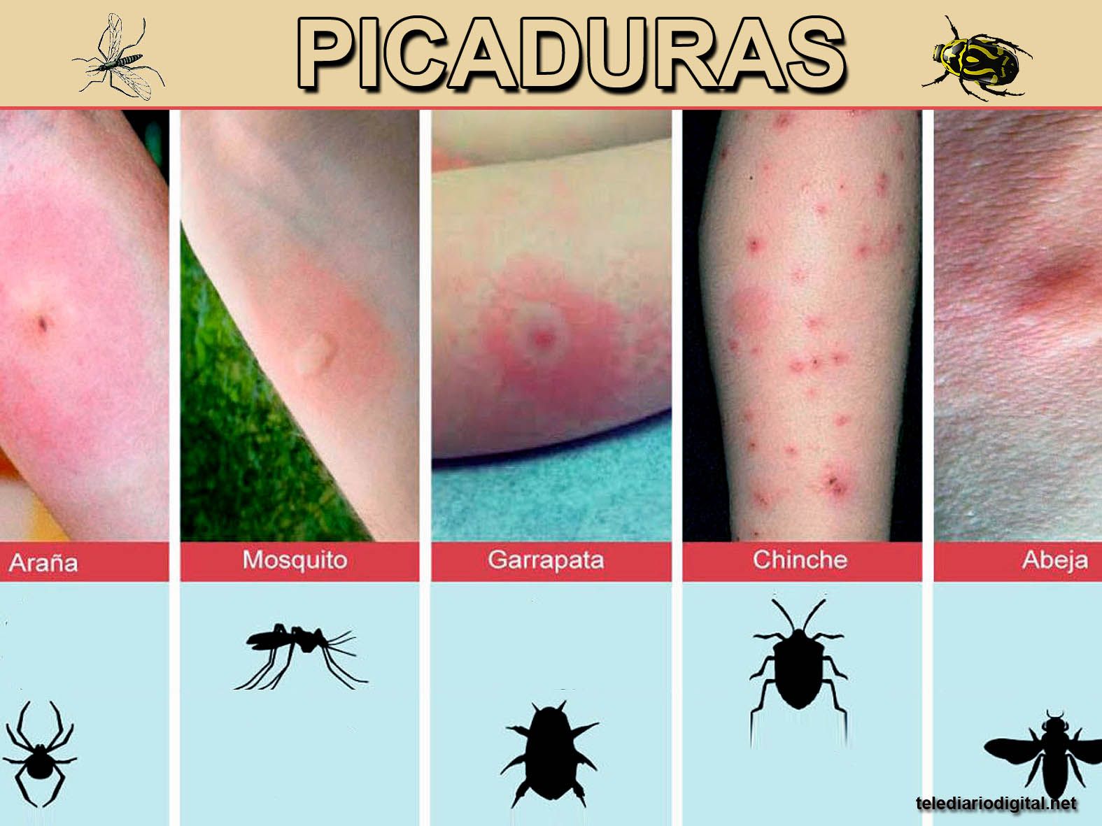 Como calmar las picaduras de mosquitos